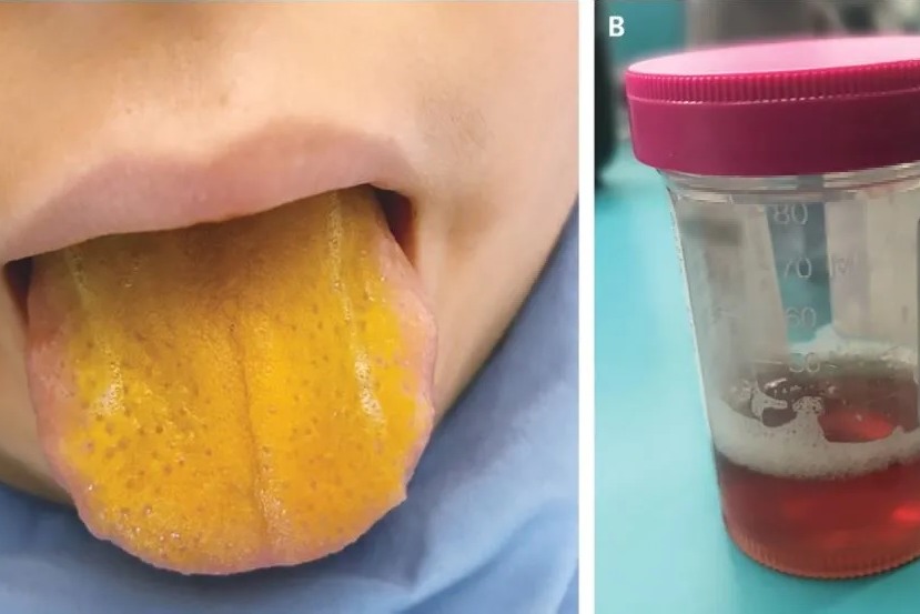 Boy Tongue Changed To Yellow Suffered Auto Immune Disorder