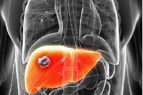 Liver abscesses most common in India -- and Covid-19 has pushed up the numbers