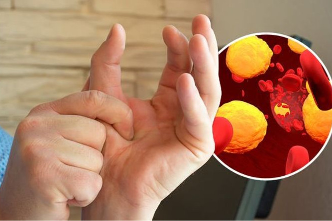 Severe pain in these parts of the body could be a warning sign of high cholesterol