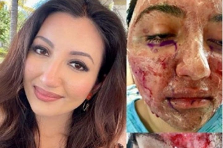 Indian-American Miss World 2021 first runner-up lives with pacemaker, survived facial burns