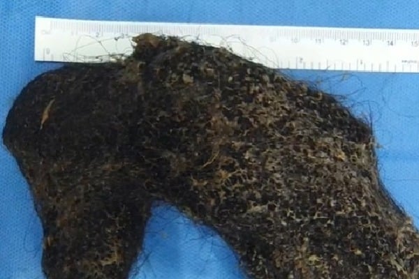 Doctors at Hyderabad hospital remove hairball from Omani girl