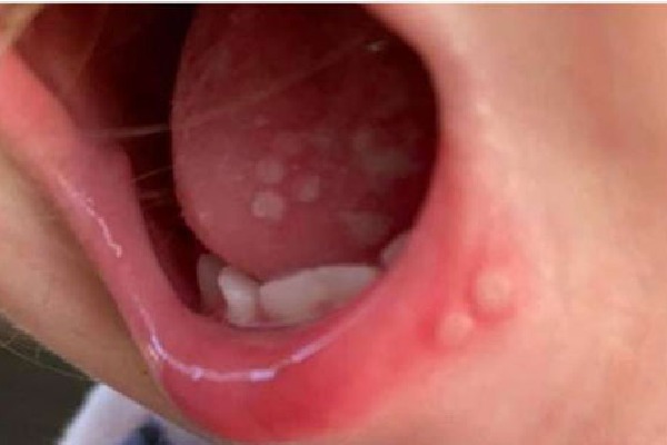 Kerala registers new cases of Tomato Flu Virus