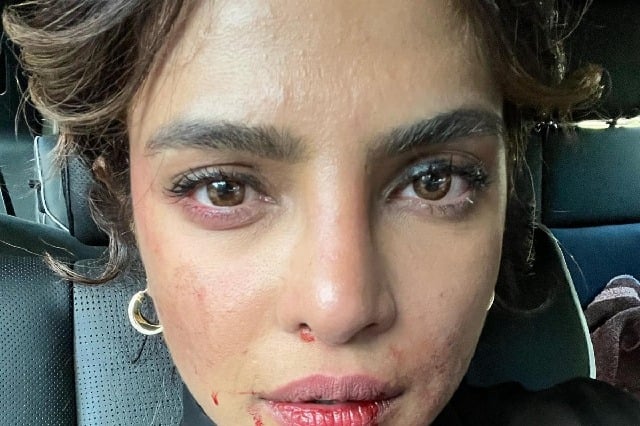 Priyanka Chopra shares picture of 'bruised' face from 'Citadel' set