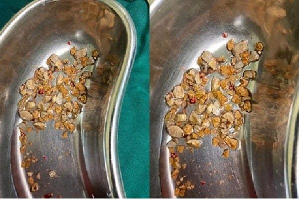 206 kidney stones removed from man in Hyderabad