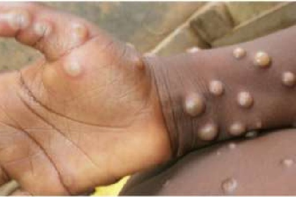 US sees first monkeypox case of 2022 as Europe reports small outbreaks