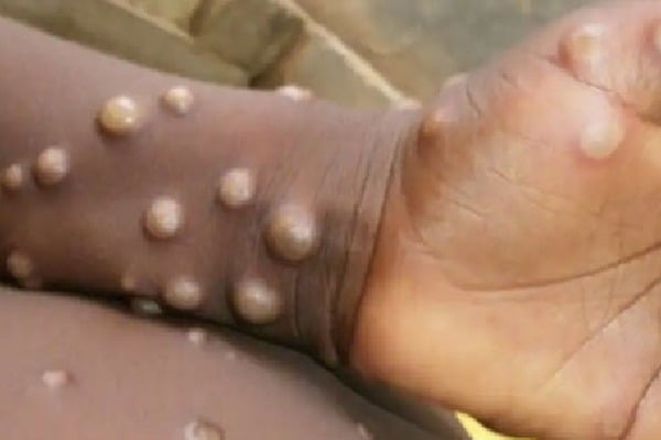 Monkeypox cases to rise globally warns WHO 