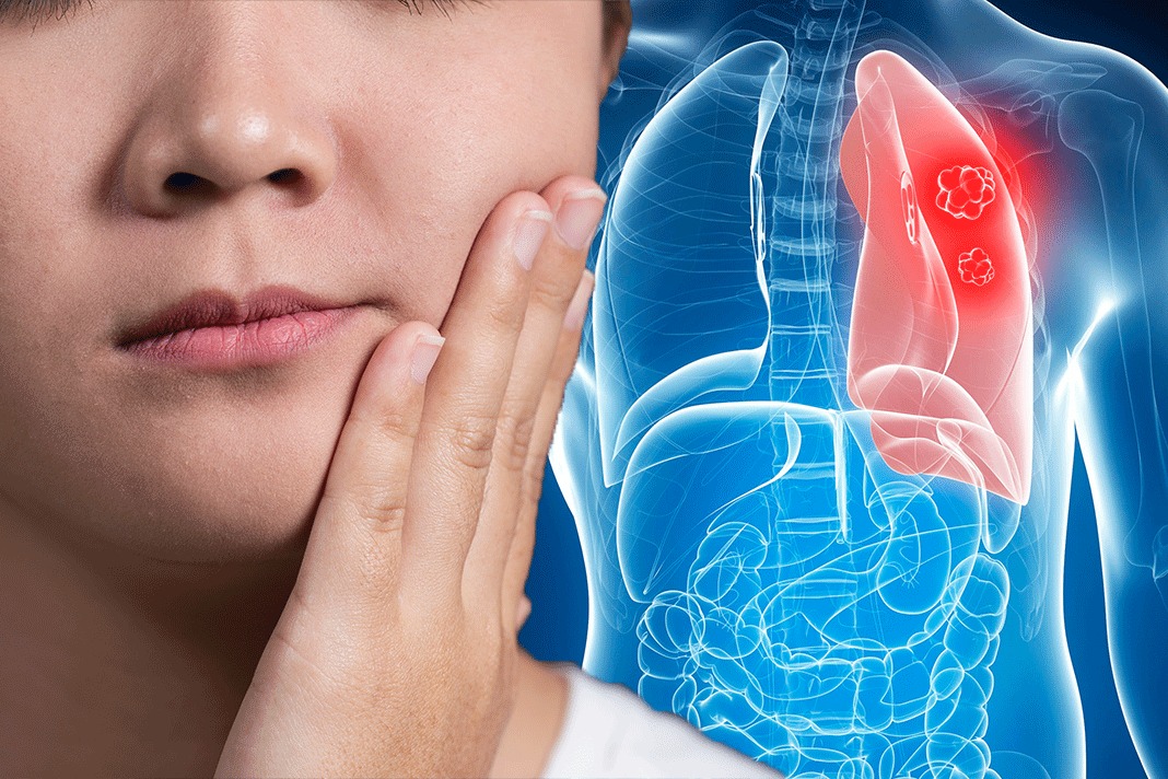 Lung Cancer Symptoms Many Patients Experience Pain In These Parts Of The Face