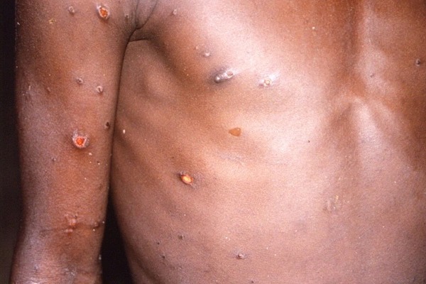 Suspected Monkey Pox Case In India