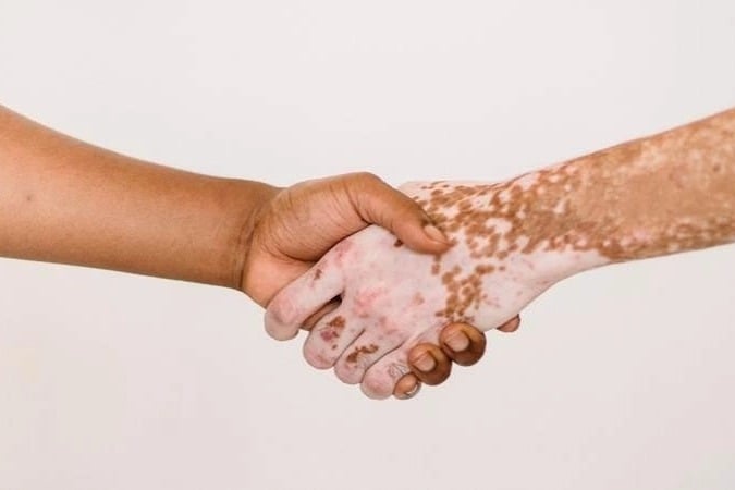 Signs to detect Vitiligo
