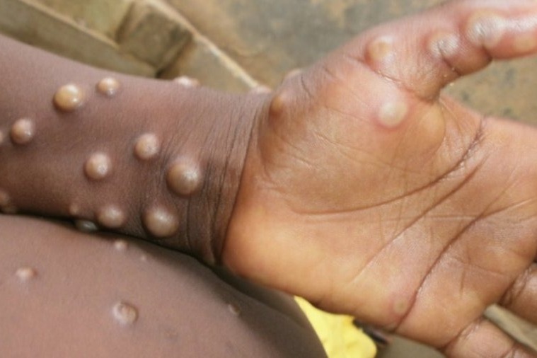 High skin lesions, low fever new symptoms of monkeypox: Lancet