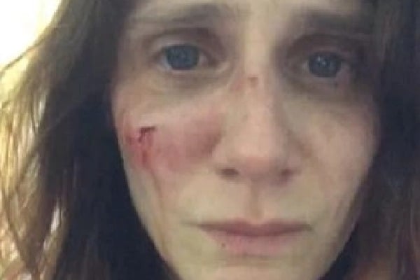 Victim of domestic abuse, French actress posts shocking pics on Instagram