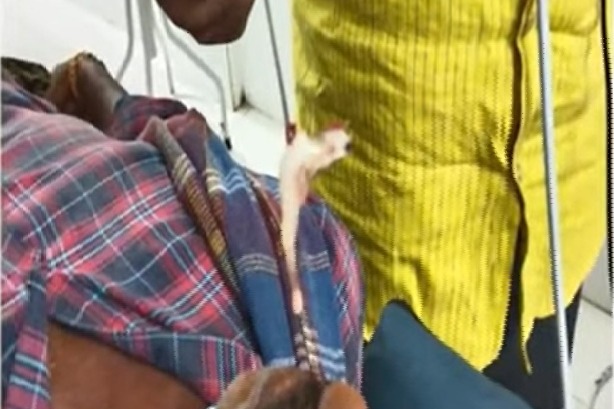 Prawn stuck in mans nose in Eluru district