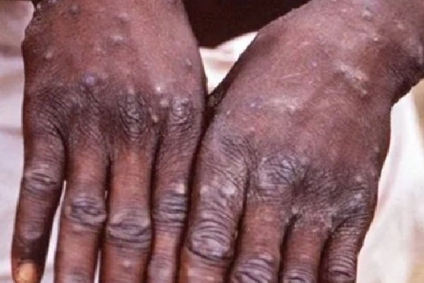 Suspected case of monkeypox in Kerala, sample sent for testing
