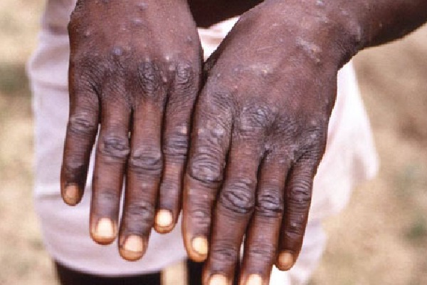 One case of monkeypox infection confirmed in Kerala