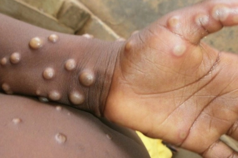 Third monkeypox case confirmed in kerala