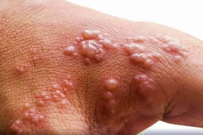 Delhi reports first monkeypox case