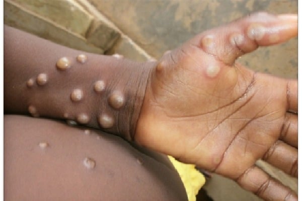 Indias first monkeypox patient recovers and skin rash completely cured