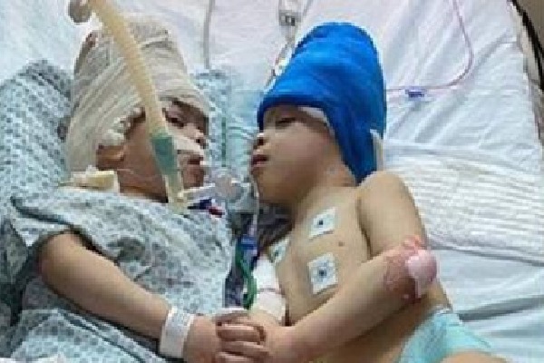 Doctors successfully separates Brazilian conjoined twins 