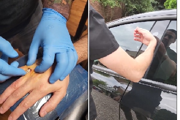 Man implants his tesla car key in his hand