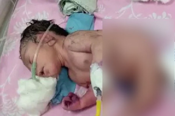Baby born with horn like structure instead of legs in Madhya Pradesh
