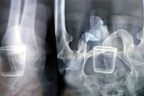 Glass found in stomach of elderly man claims he was made to sit on it in Madhyapradesh