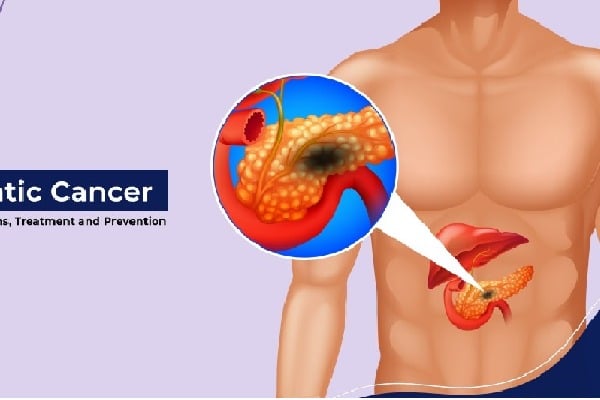 Pancreatic cancer could be diagnosed up to three years earlier new study