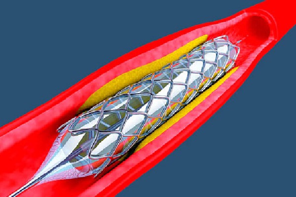 Coronary Stent Is Now In Essential Medicine List