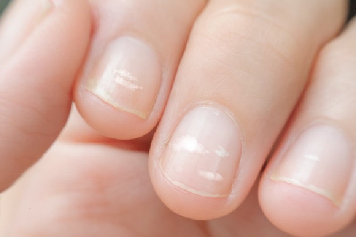 those white spots on your nails are not due to a calcium deficiency