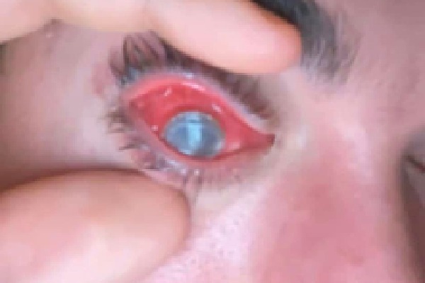 Man lost his eye due to parasites formed under contact lenses 