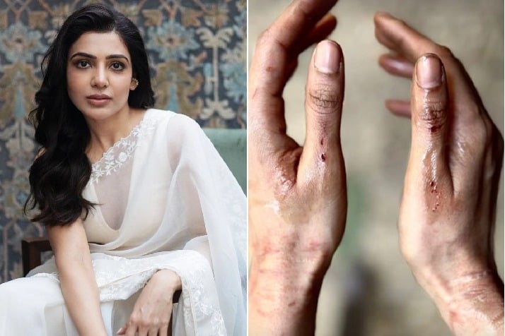 Samantha Ruth Prabhu shares pictures of bruised hands from 'Citadel' shoot