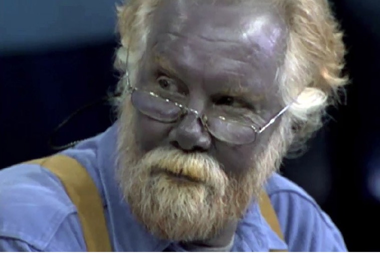 The man who turned blue after taking a dietary supplement for years