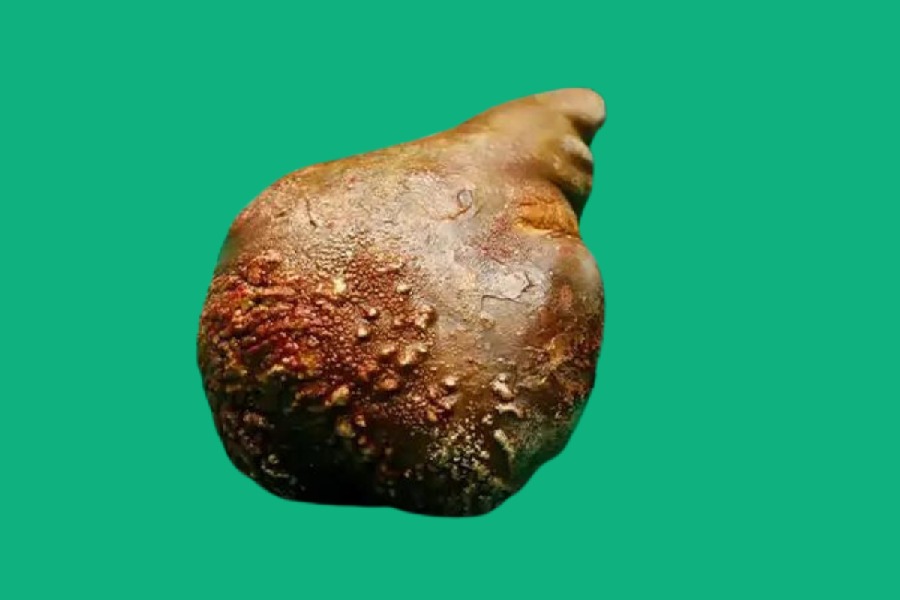 Sri Lankan Doctors Removed World Largest Kidney Stone