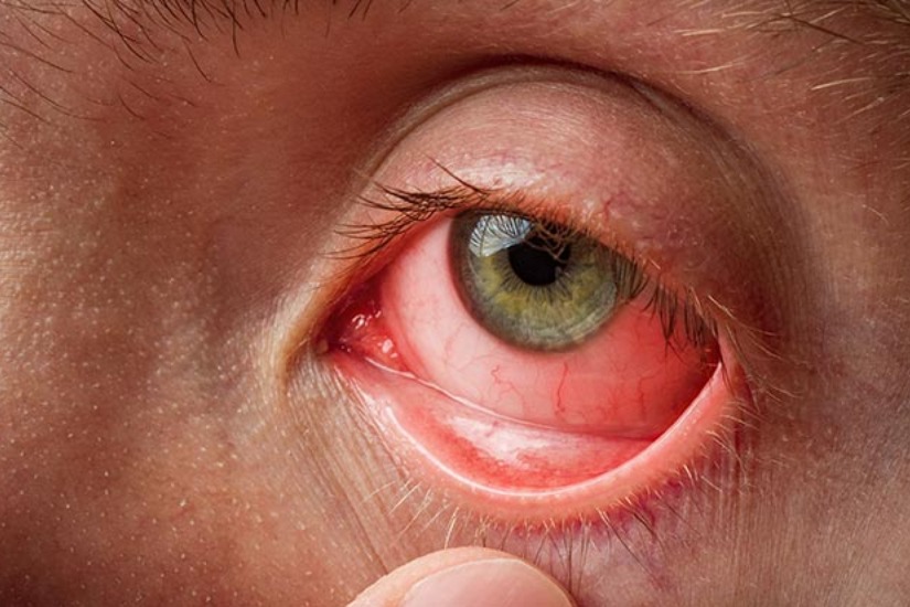 Medicos warns against indiscriminate use of steroids for conjunctivitis