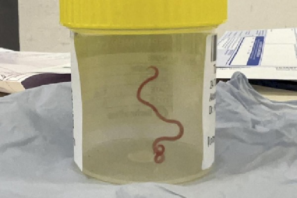 Doctors remove 3 inch parasitic worm from womans brain in world first