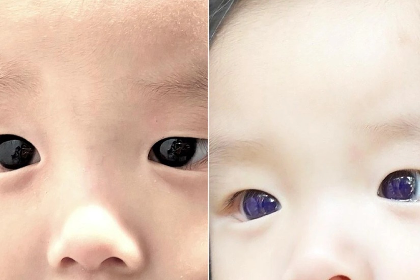 Babys Dark Brown Eyes Turn Blue After Covid 19 Treatment In Thailand