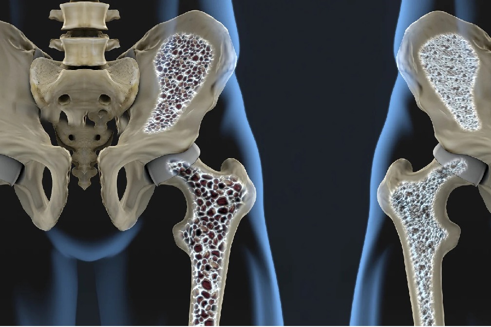 India ranks number one in Osteoporosis cases