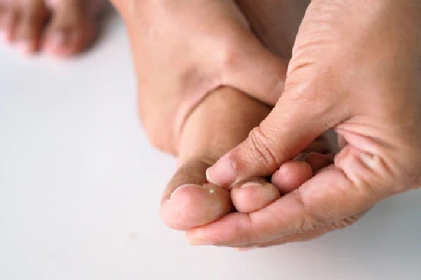 How diabetes can affect health of your skin and feet