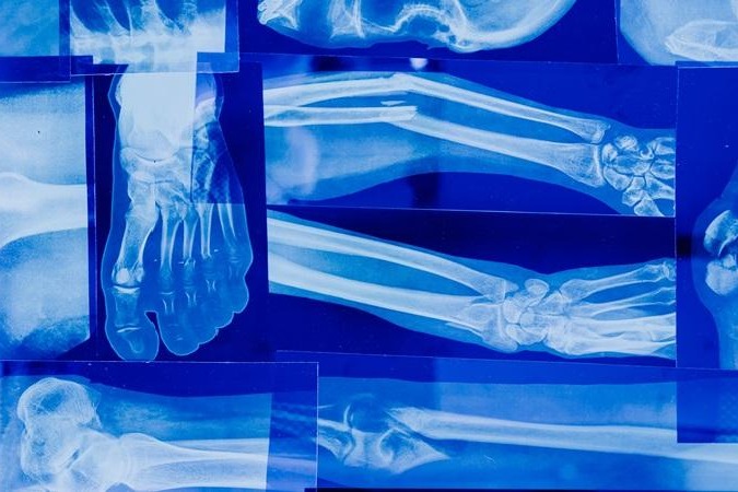 Exposure to PFAS may affect bone health in adolescents & young adults