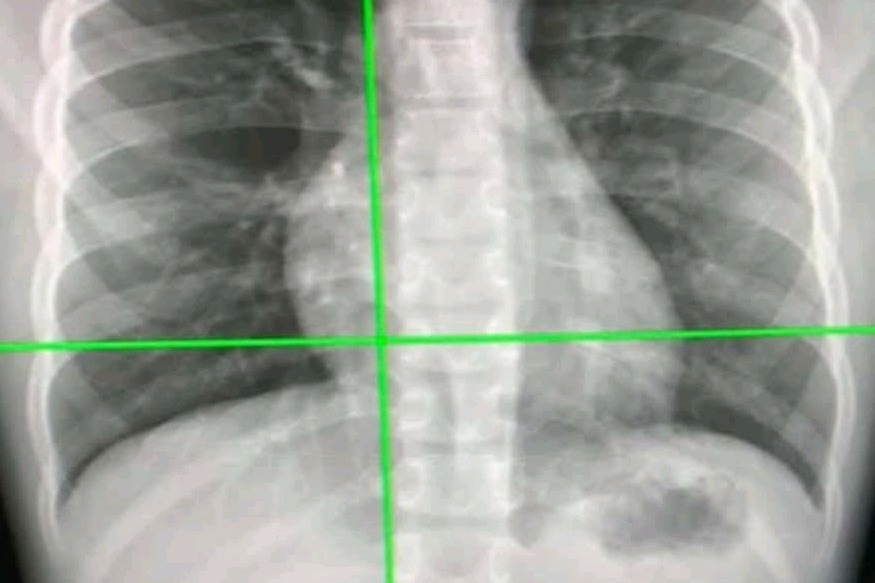 New AI tool can detect Covid infection from chest X-rays 98% accuracy