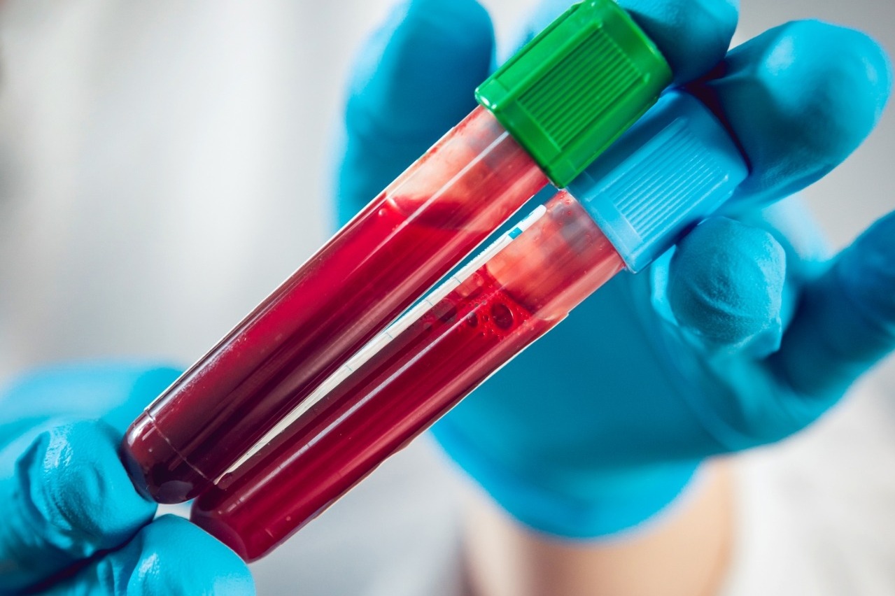 New blood test can spot Alzheimer's risk 15 yrs before symptoms appear