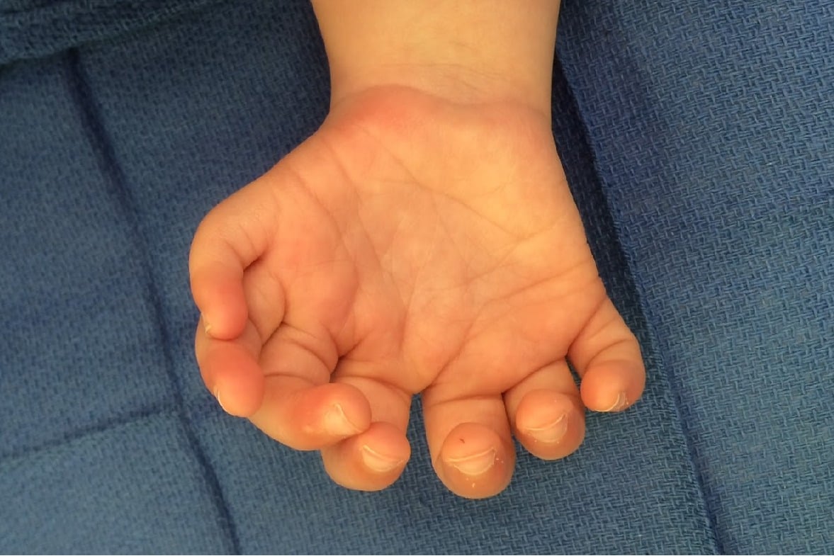 Study finds rare disorder behind extra fingers and toes