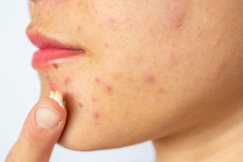 Doctors Recommend Chilling Acne Creams Before Use To Reduce Cancer Risk