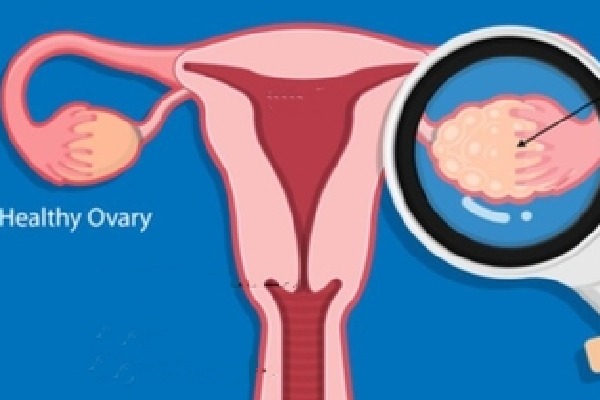 Routine screening key for early detection of ovarian cancer: Experts