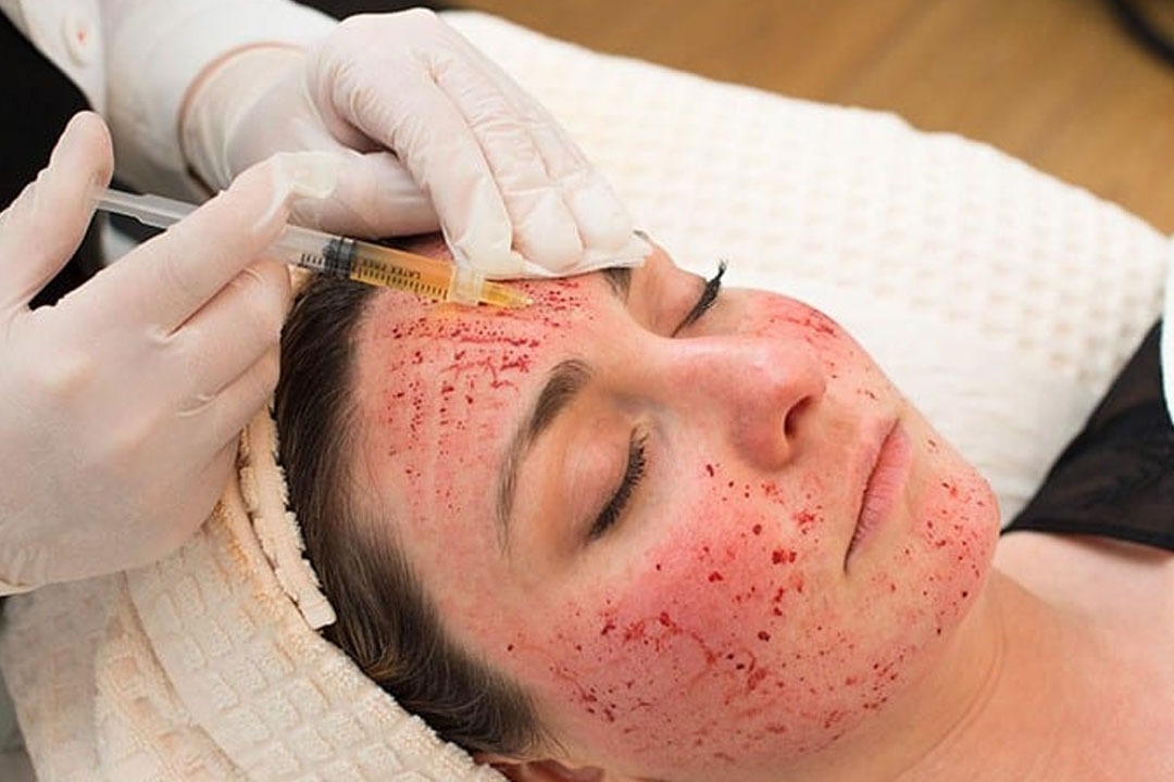 At Least 3 Women Contracted HIV After Getting Vampire Facial At Spa 