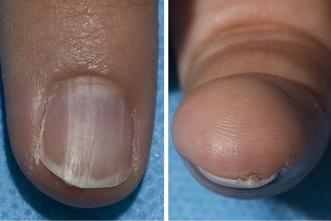 How your nail colour can signal cancer risk