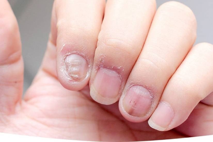 Nails as indicators of underlying health symptoms