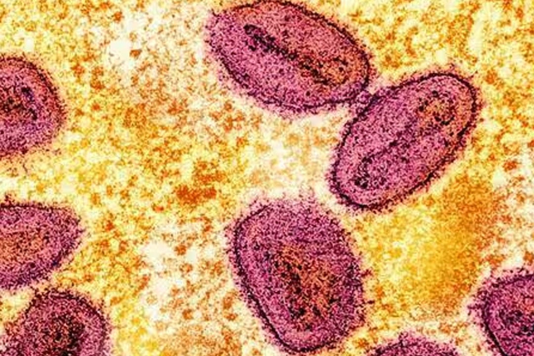 India reports first mpox case of clade 1b from Kerala