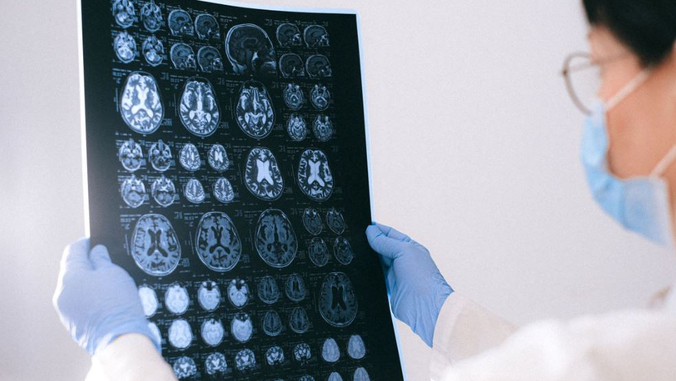Magic Mushrooms result in recovery after five years of memory loss
