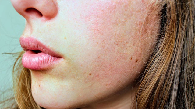 Heat Rash Home Remedies Found In Your Refrigerator To Treat Itching And Redness