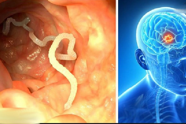 Parasitic worm lives in brain for seventeen years 